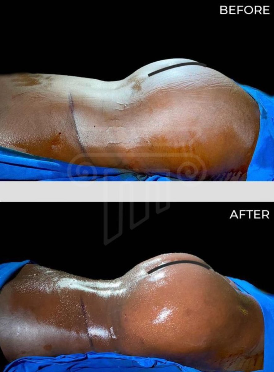 نتائج قبل وبعد عملية Brazilian Butt Lift في عيادة Dr. Safa Manav، تحسين شكل الأرداف