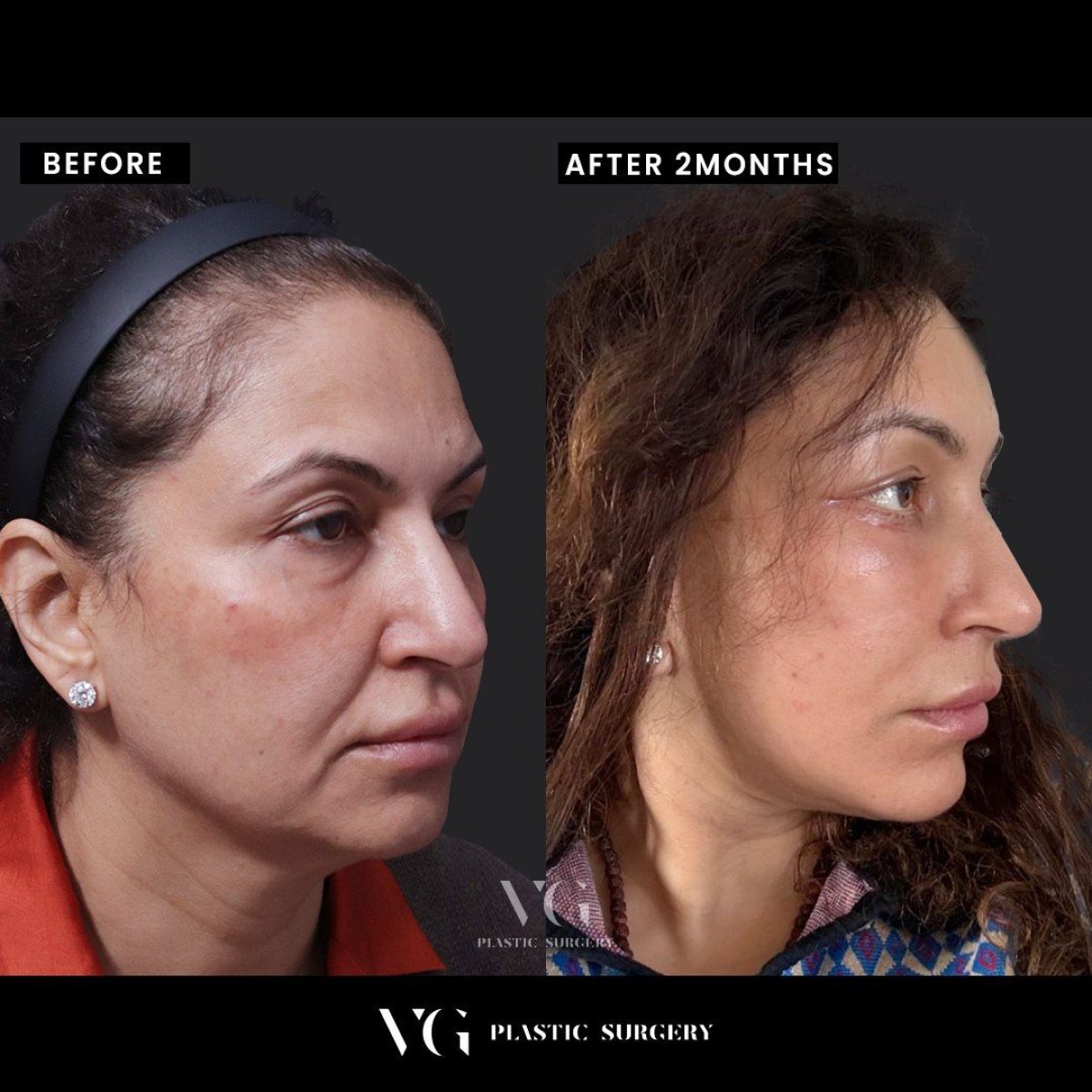 Before and after facial feminization surgery results at VG Plastic Surgery, 2 months post-op