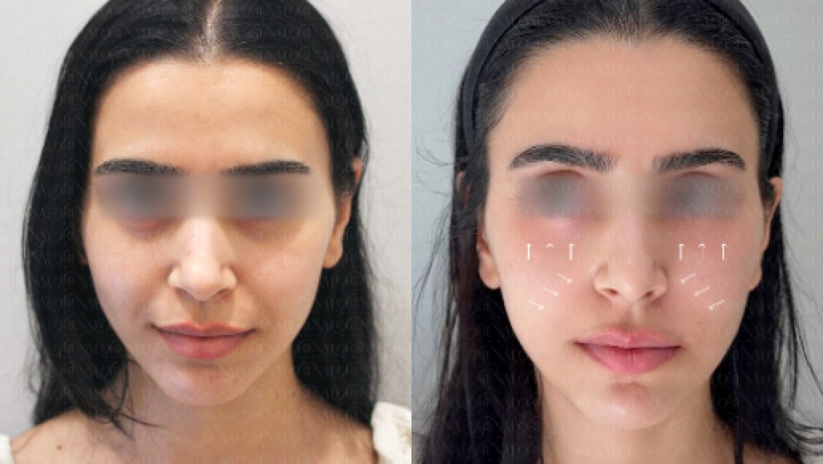 Before and after skin rejuvenation results at Forena Clinic, improved facial skin texture