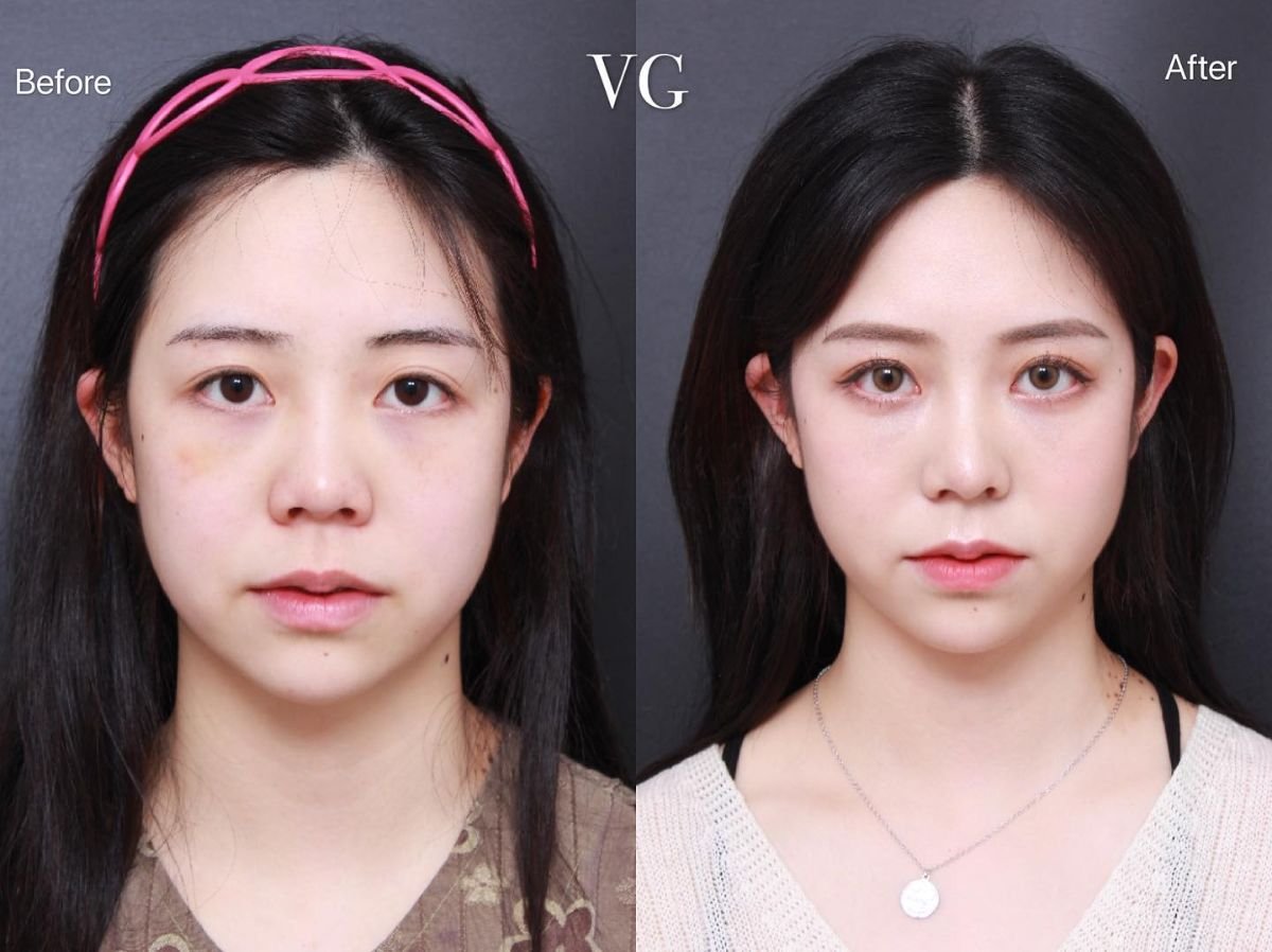 نتائج قبل وبعد عملية تجميل الأنف التصحيحية في VG Plastic Surgery، تحسين شكل الأنف