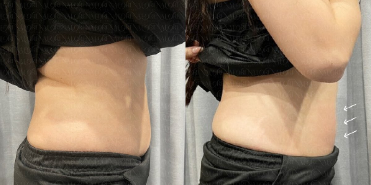 Before and after BodyTite body contouring results at Forena Clinic, visible waist slimming
