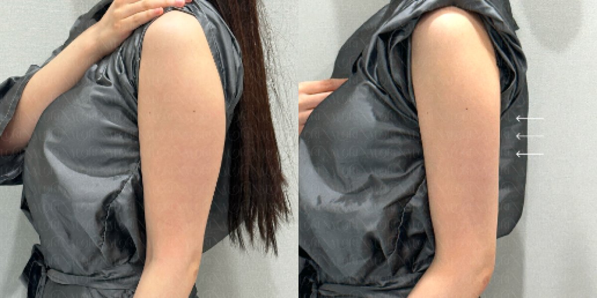 Resultado antes y después de BodyTite en Forena Clinic, mejora de la forma del brazo