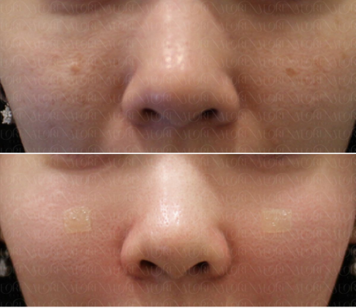 Before and after stem cell rejuvenation therapy result at Forena Clinic, improved facial skin texture