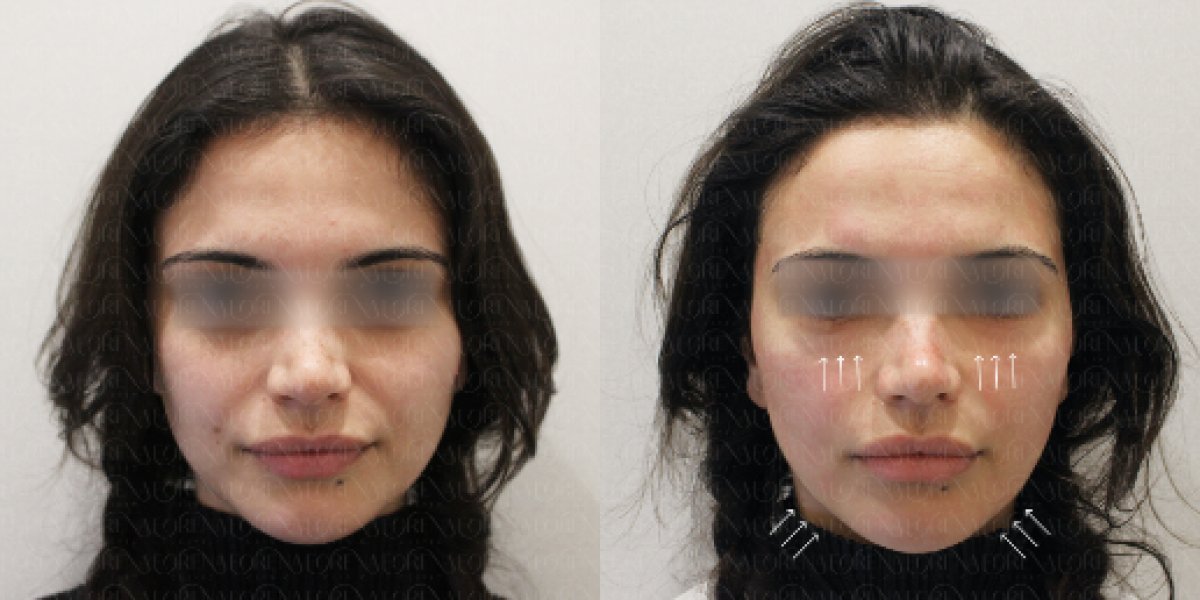 Thermage face lifting before and after results at Forena Clinic – visible skin tightening effect