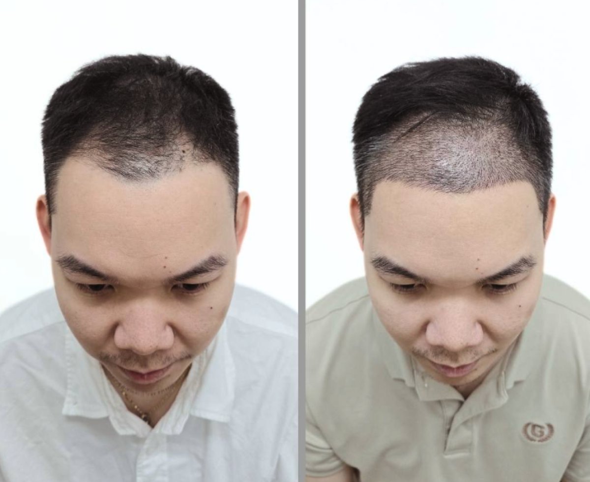 نتائج زراعة الشعر قبل وبعد في Dr.Nutt Clinic، خط شعر وكثافة محسّنة
