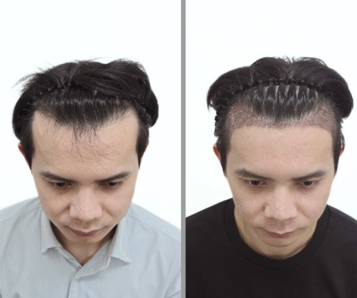 نتائج زراعة الشعر قبل وبعد في عيادة Dr.Nutt، استعادة خط الشعر الأمامي