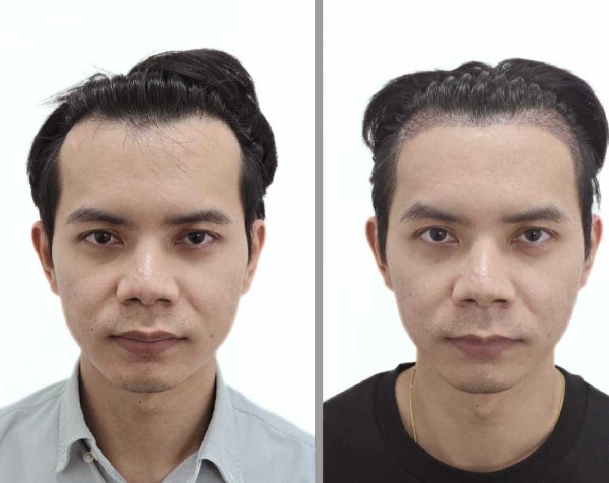 نتائج زراعة الشعر قبل وبعد في عيادة Dr.Nutt، خط شعر وكثافة محسنة