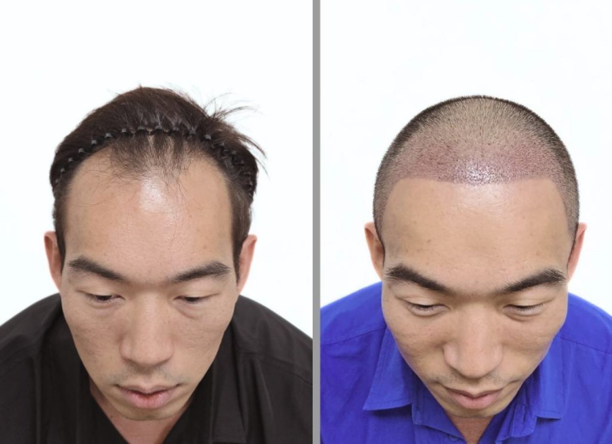 نتائج زراعة الشعر قبل وبعد في عيادة Dr.Nutt، استعادة خط الشعر لدى مريض ذكر