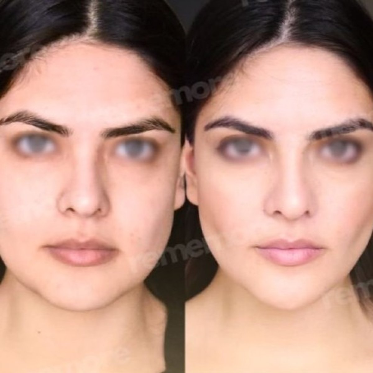Before and after cheekbone reduction results at Memorial Şişli Hospital, facial contouring