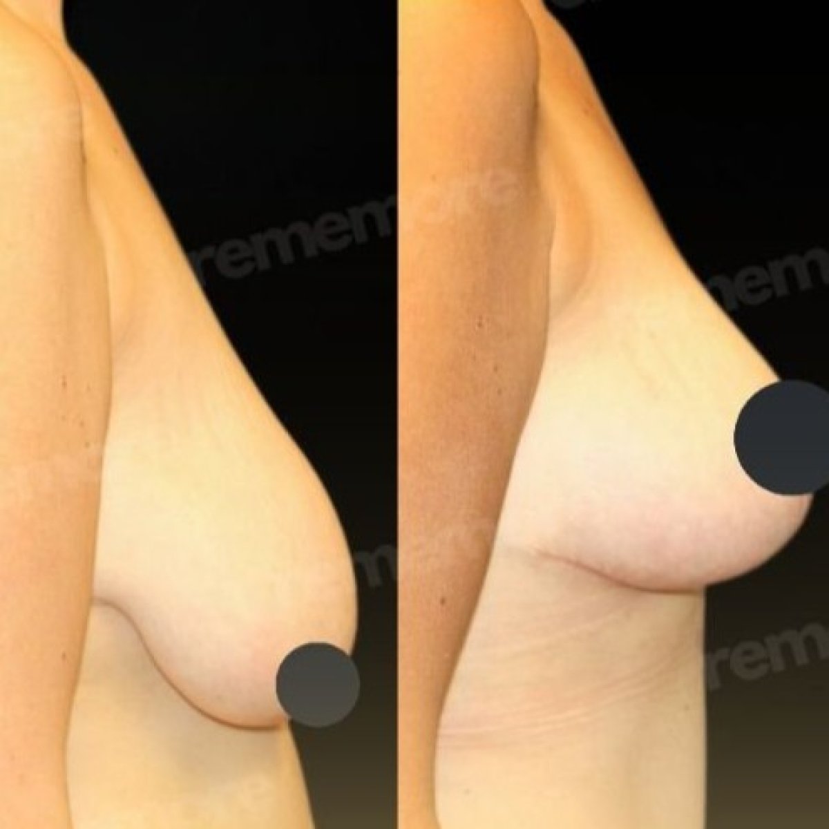 Before and after breast lift results at Memorial Bahçelievler Hospital, improved breast contour