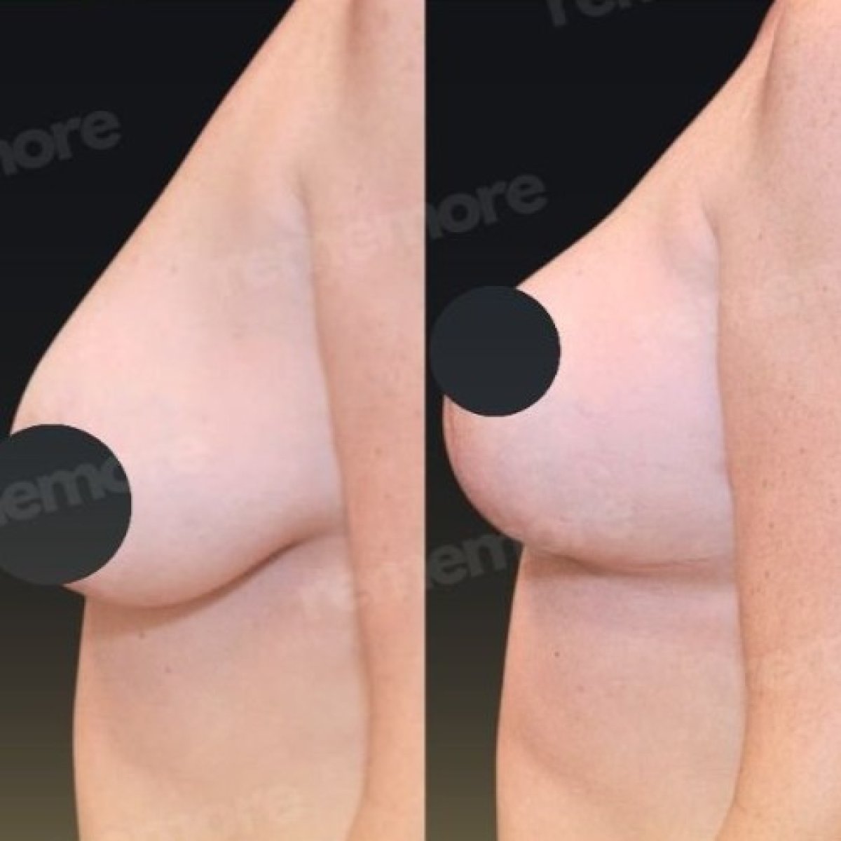 Before and after breast lift results at Memorial Bahçelievler Hospital, improved breast contour