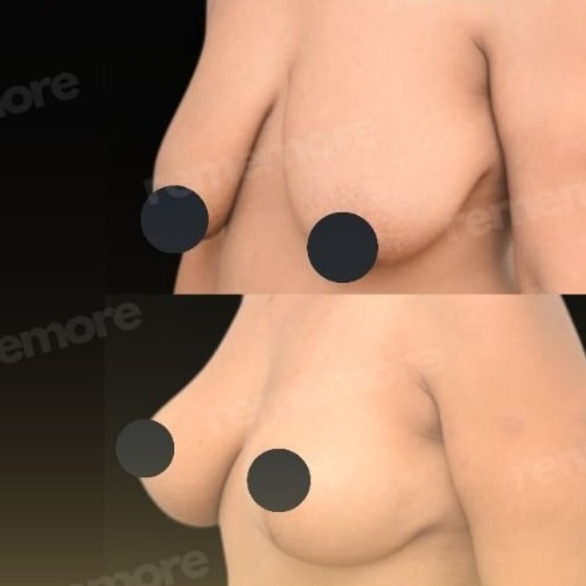 Before and after breast lift results at Memorial Bahçelievler Hospital, improved breast contour