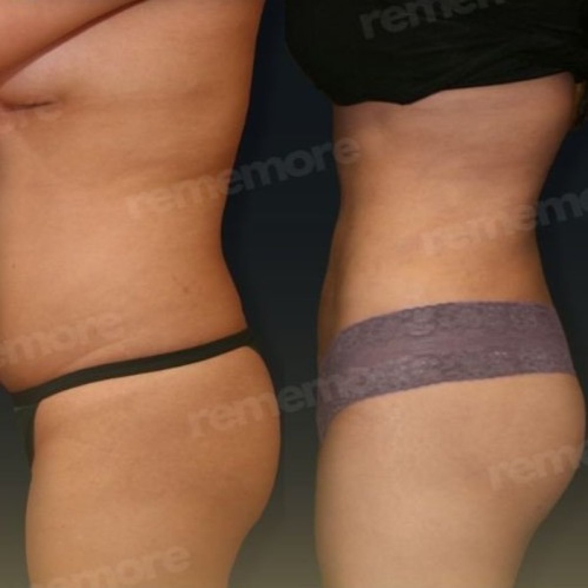 Résultats avant et après liposuccion du dos à Memorial Antalya Hospital, silhouette affinée
