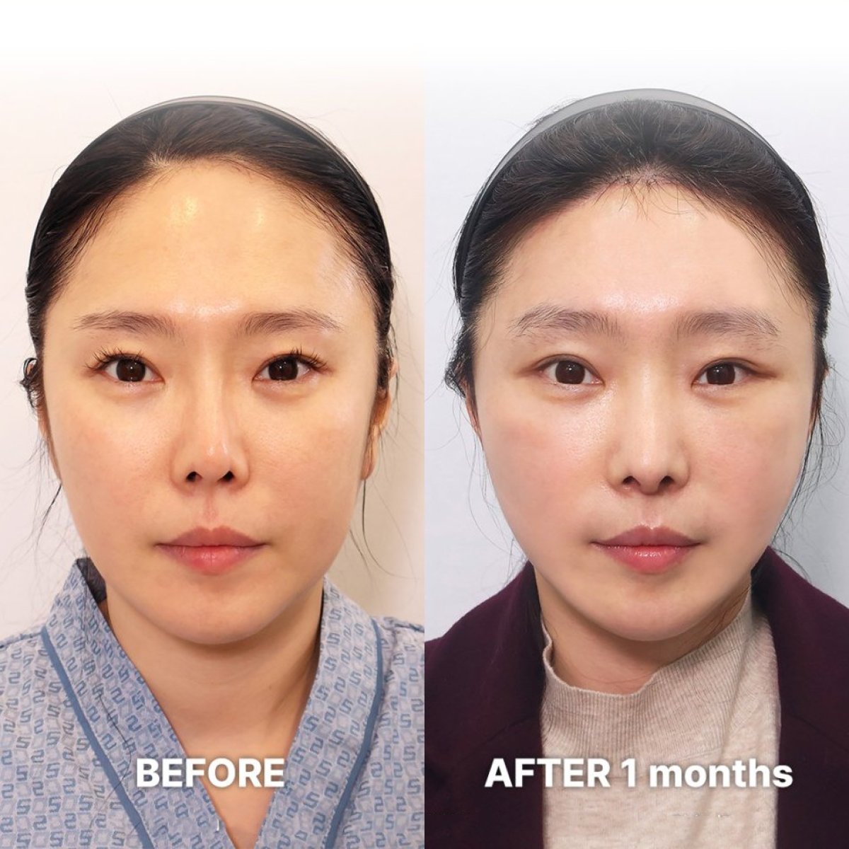 Before and after deep plane facelift results at Returning Plastic Surgery, facial rejuvenation