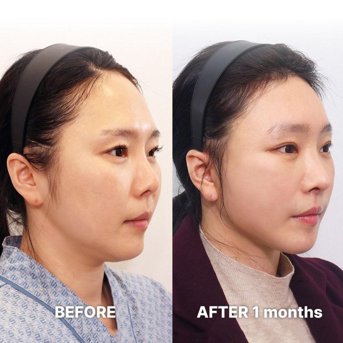 Before and after deep plane facelift results at Returning Plastic Surgery, visible facial lift