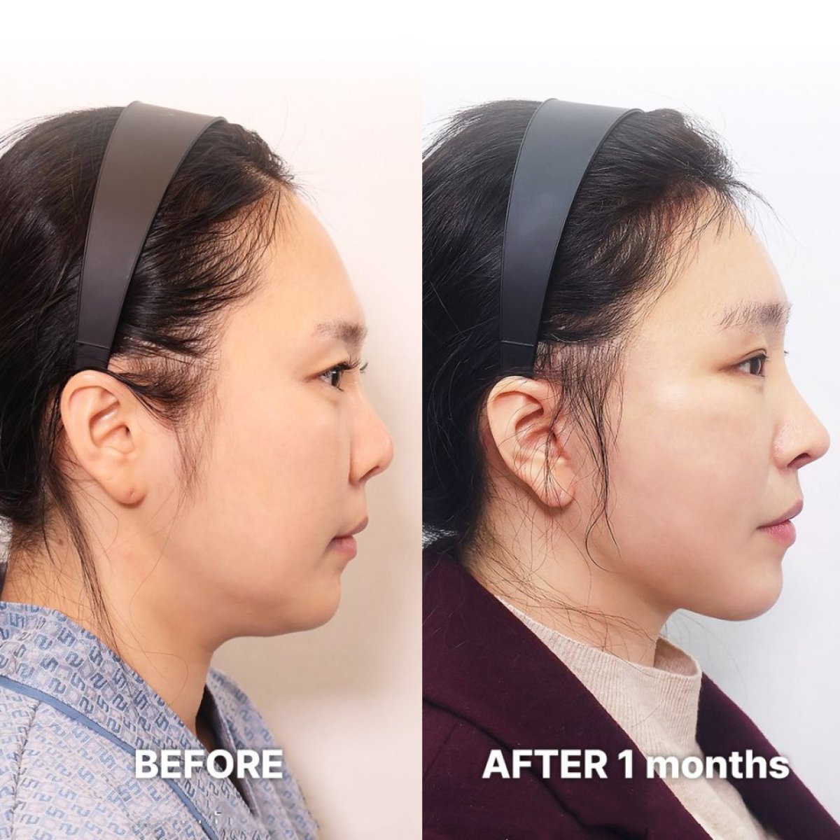 Résultats avant/après lifting deep plane chez Returning Plastic Surgery, contour du visage visible