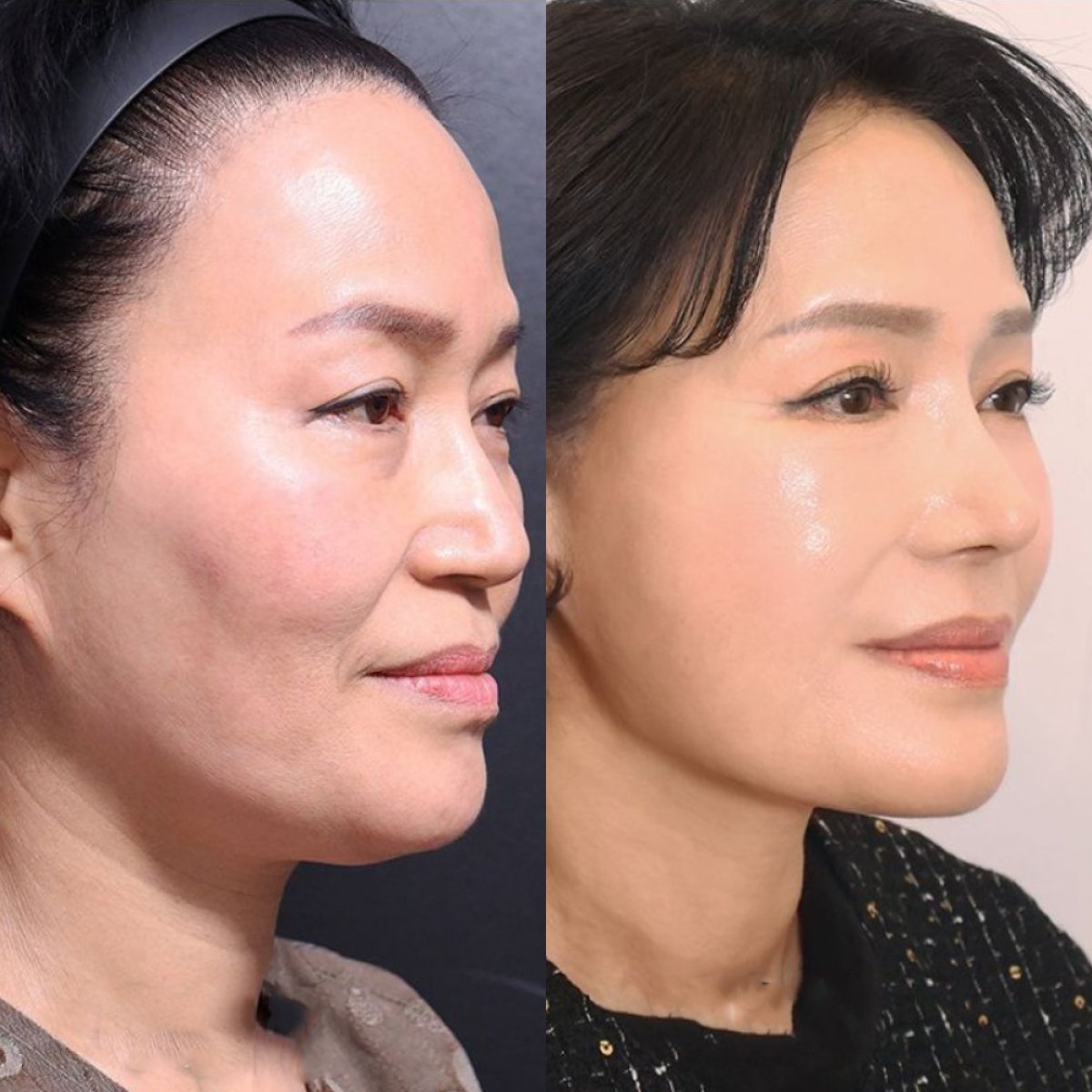 Before and after deep plane facelift results at Returning Plastic Surgery, facial rejuvenation
