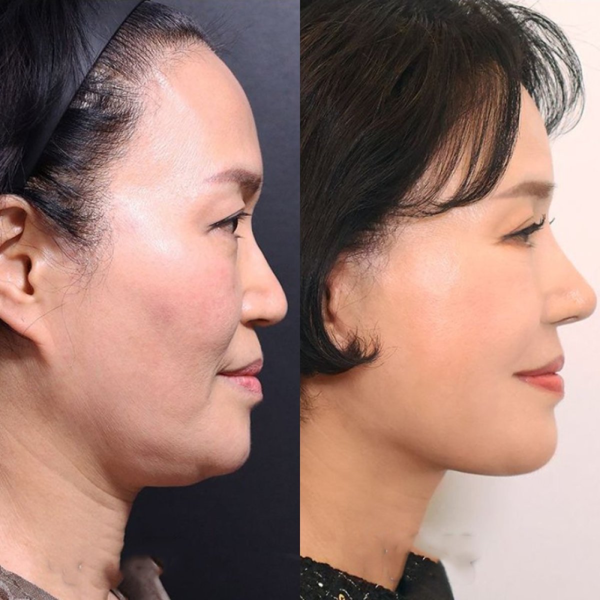 Before and after deep plane facelift results at Returning Plastic Surgery, facial rejuvenation