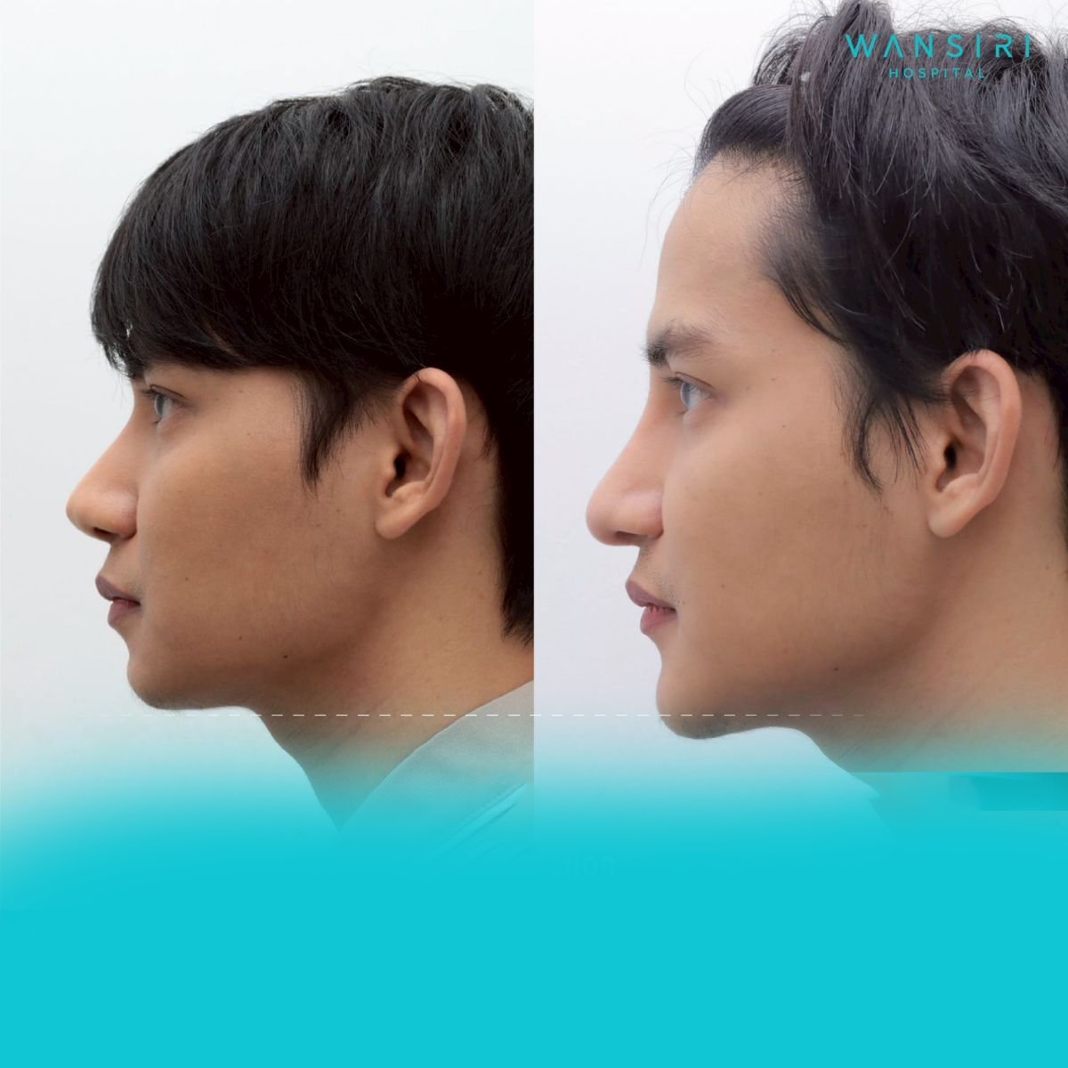 Resultados antes y después de masculinización facial en Wansiri Hospital, realce de mandíbula