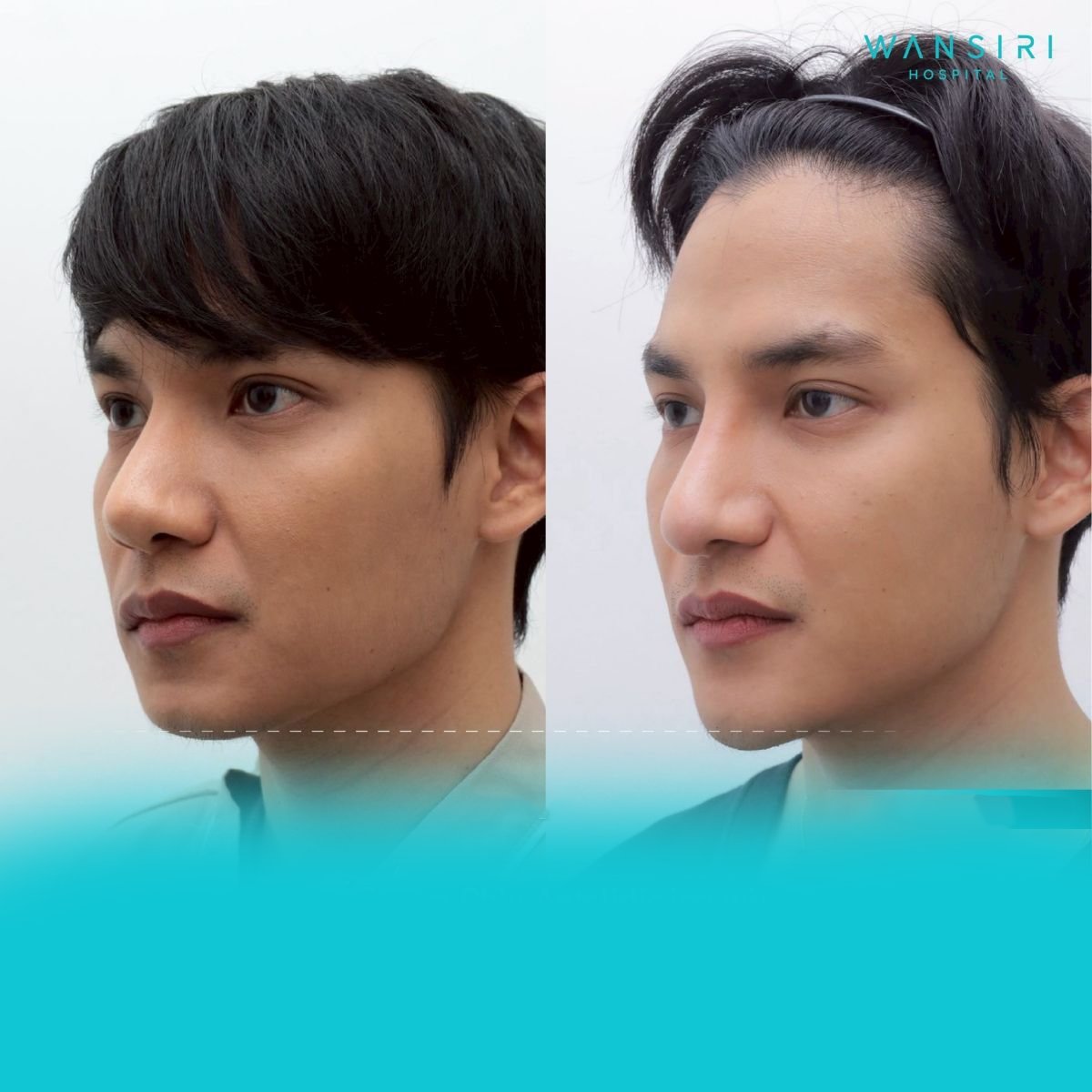 Facial masculinization surgery before and after results at Wansiri Hospital, enhanced jawline