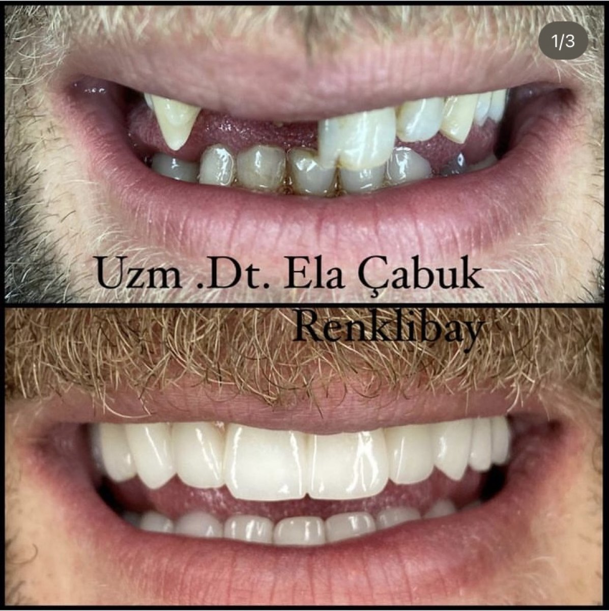 Before and after dental implant results at Dr. Ela Cabuk Renklibay's Private Dental Clinic