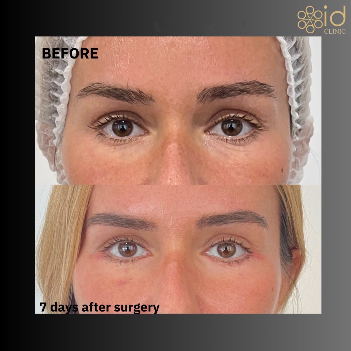 Before and after lower eyelid blepharoplasty results at ID Clinic Bangkok, 7 days post-op
