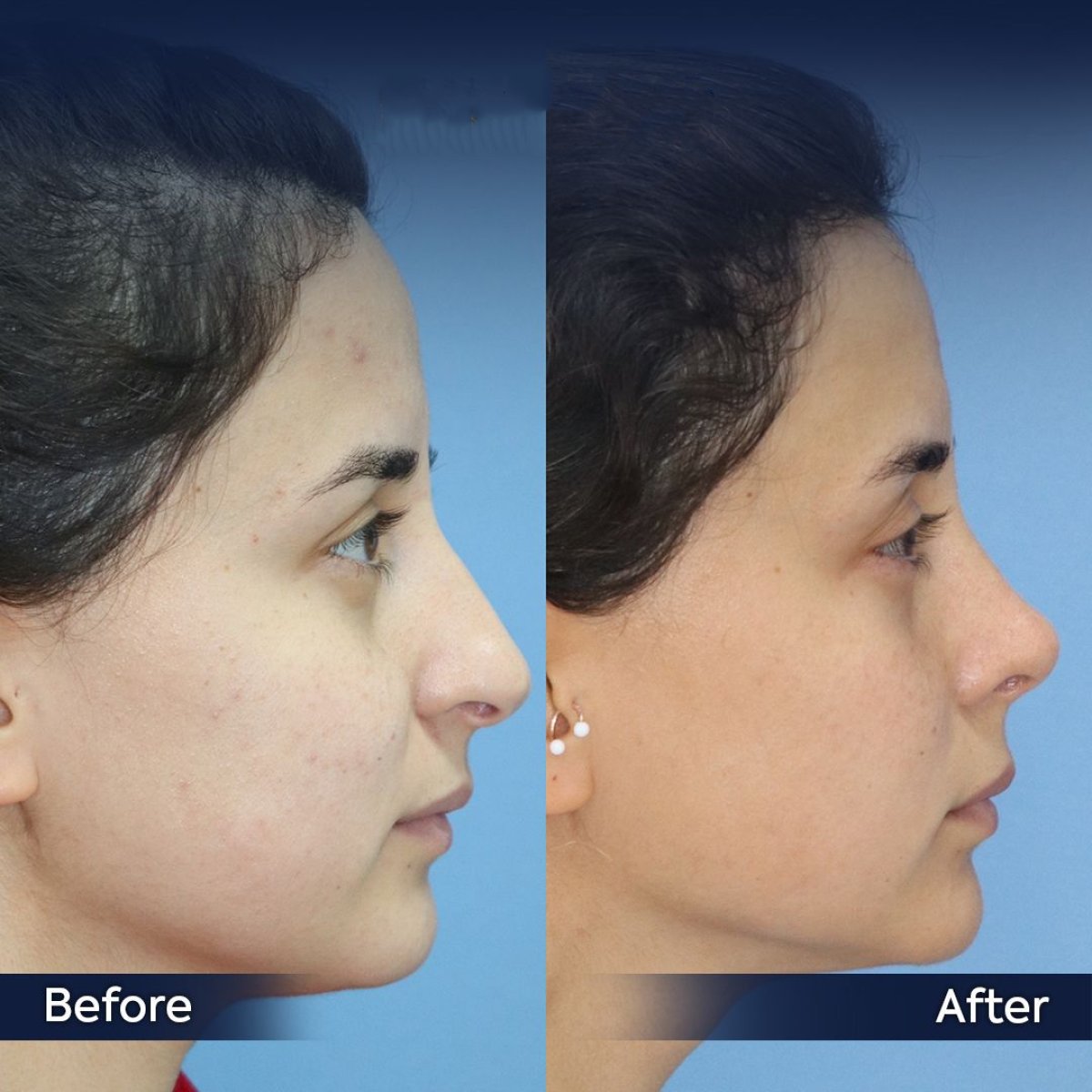 Resultados de rinoplastia antes y después en Dr. Safa Manav Clinic, perfil nasal mejorado