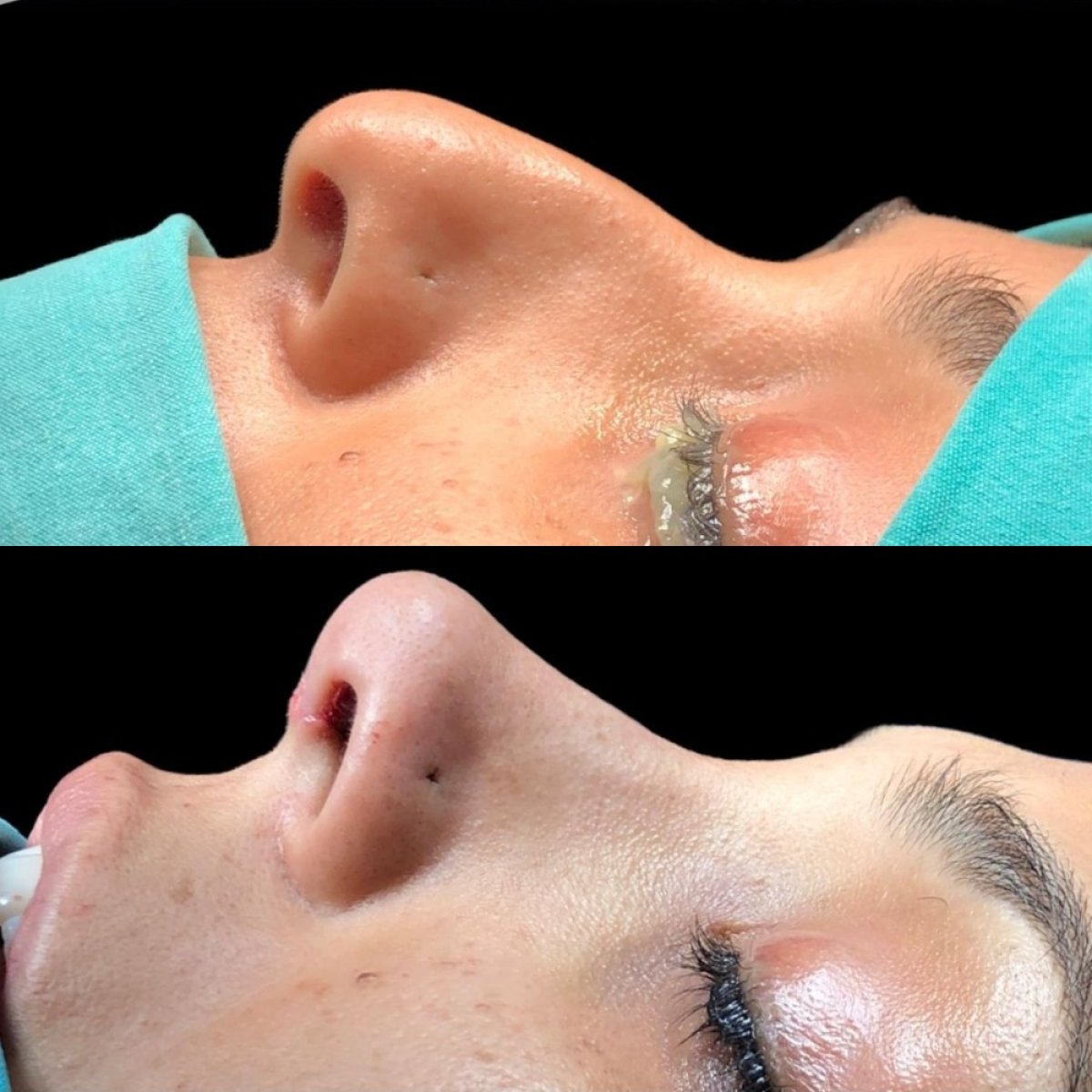 نتائج عملية تجميل الأنف قبل وبعد في عيادة Dr. Safa Manav، تحسين شكل الأنف
