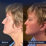 Before and after Blepharoplasty (Eyelid correction) photos by Dr. 