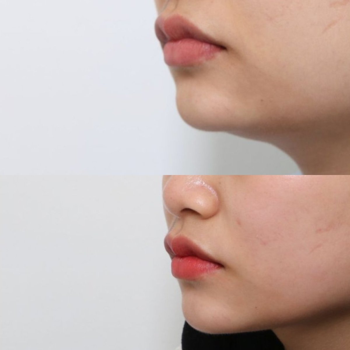 نتيجة شفط دهون الذقن المزدوج قبل وبعد في URBAN Plastic Surgery، خط فك محدد