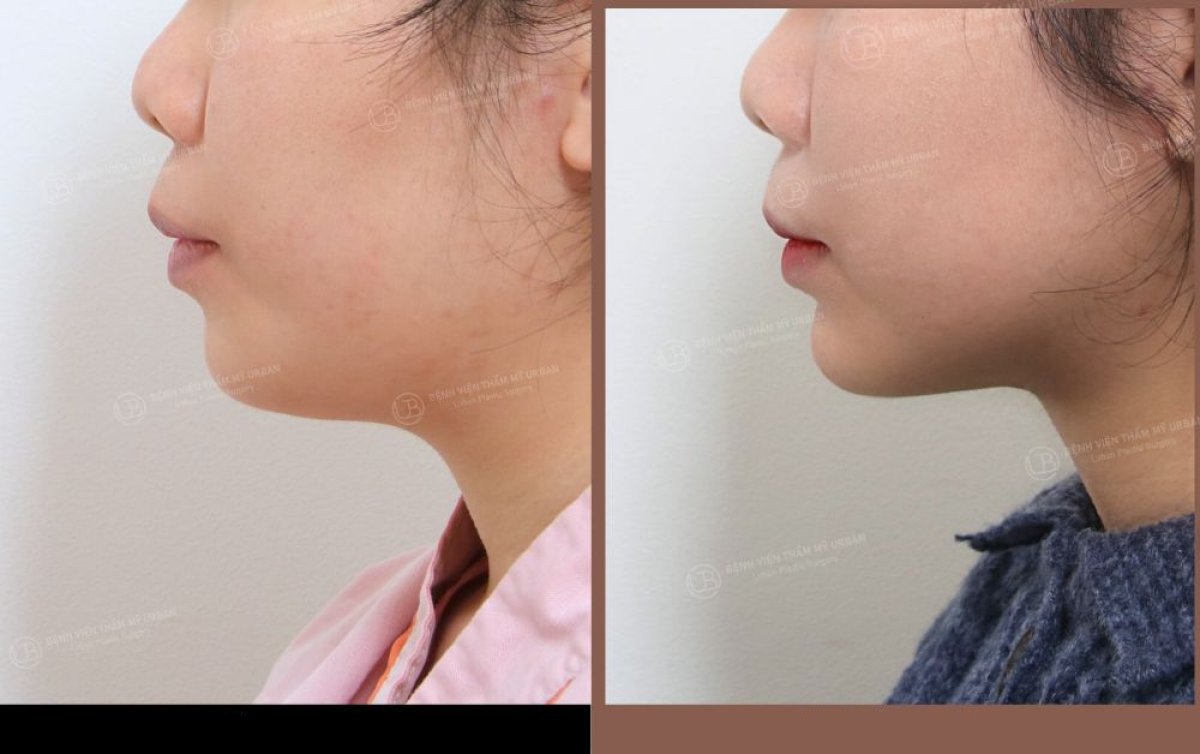 Résultat avant/après liposuccion double menton chez URBAN Plastic Surgery, contour affiné