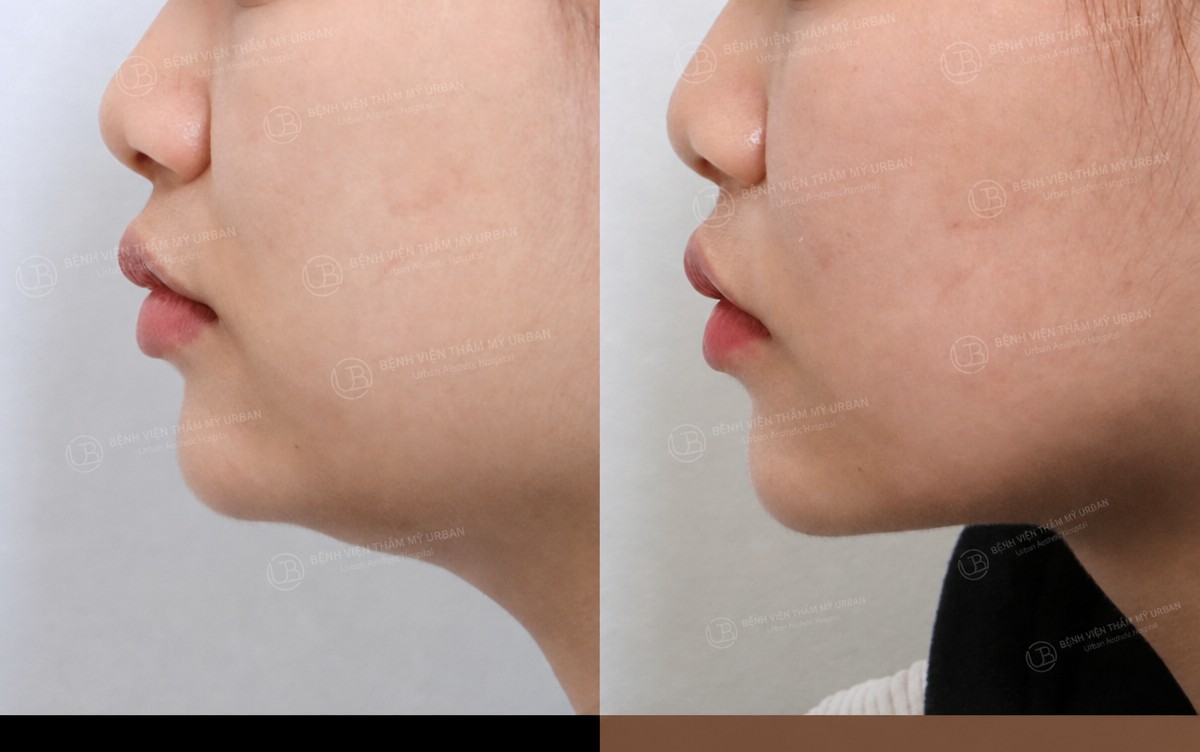 نتيجة شفط دهون الذقن المزدوج قبل وبعد في URBAN Plastic Surgery، تحديد الفك