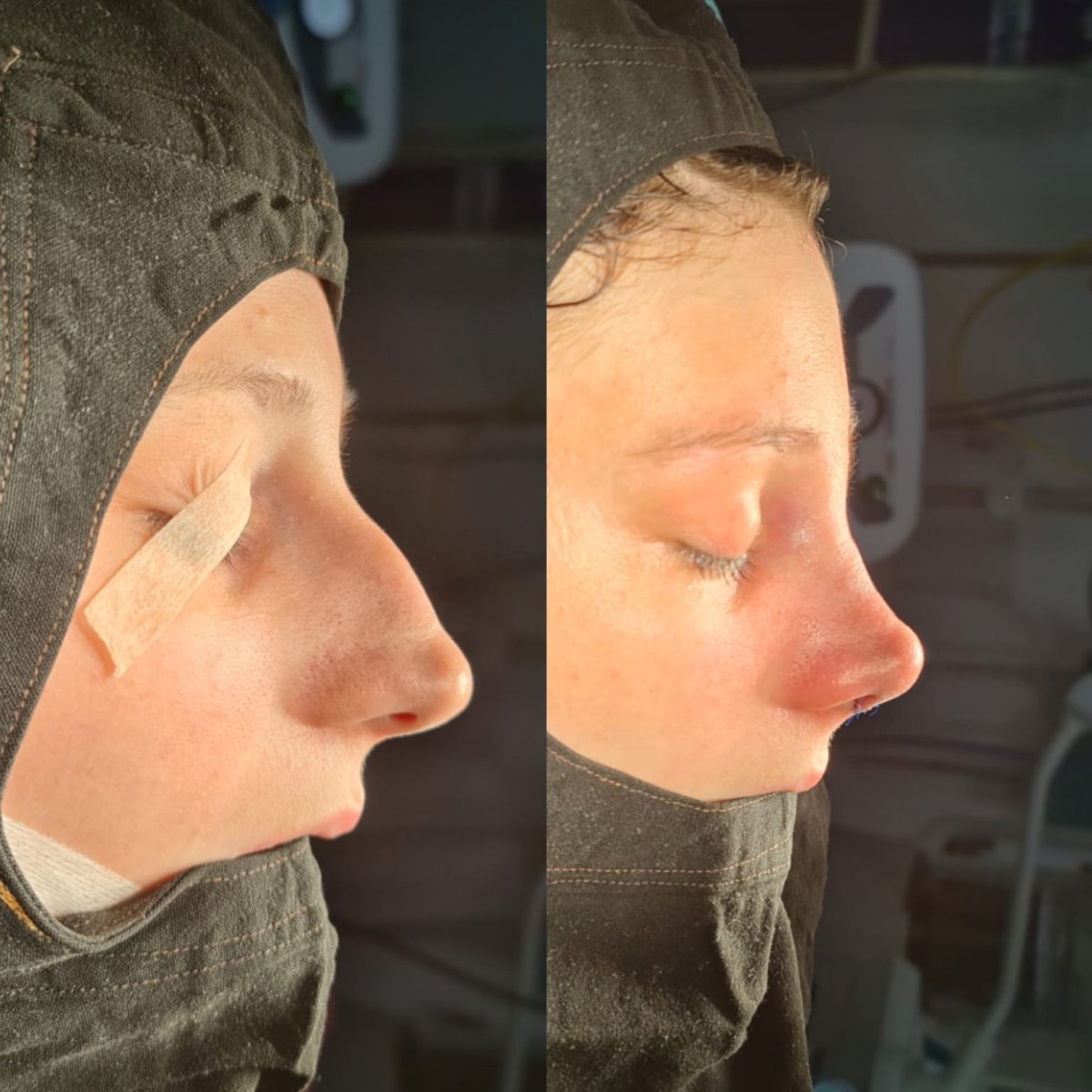 نتائج عملية تجميل الأنف قبل وبعد في ÜMRAN TIP MERKEZİ، تحسين شكل الأنف