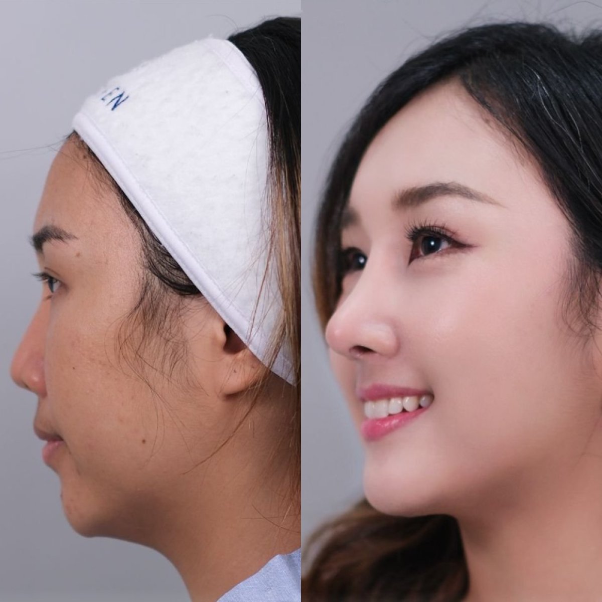 نتيجة تحديد خط الفك قبل وبعد في مركز Dr. Chen Surgery Hospital International Center