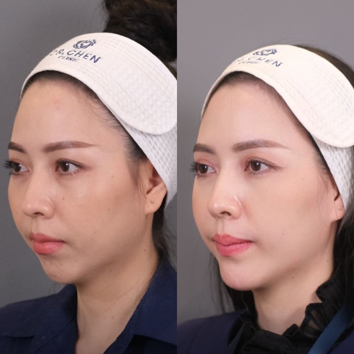 Résultats avant/après du remodelage de la mâchoire chez Dr. Chen Surgery Hospital