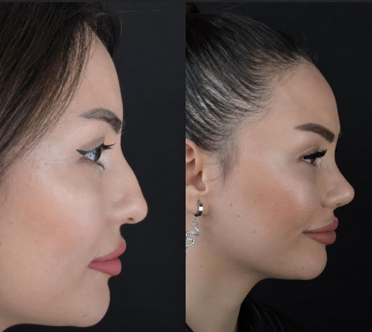 Résultats avant/après rhinoplastie à ÜMRAN TIP MERKEZİ, remodelage du nez naturel
