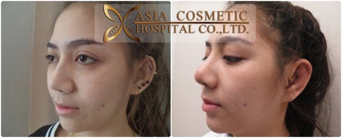 Before and after otoplasty results at Asia Cosmetic Hospital, ear reshaping with natural look