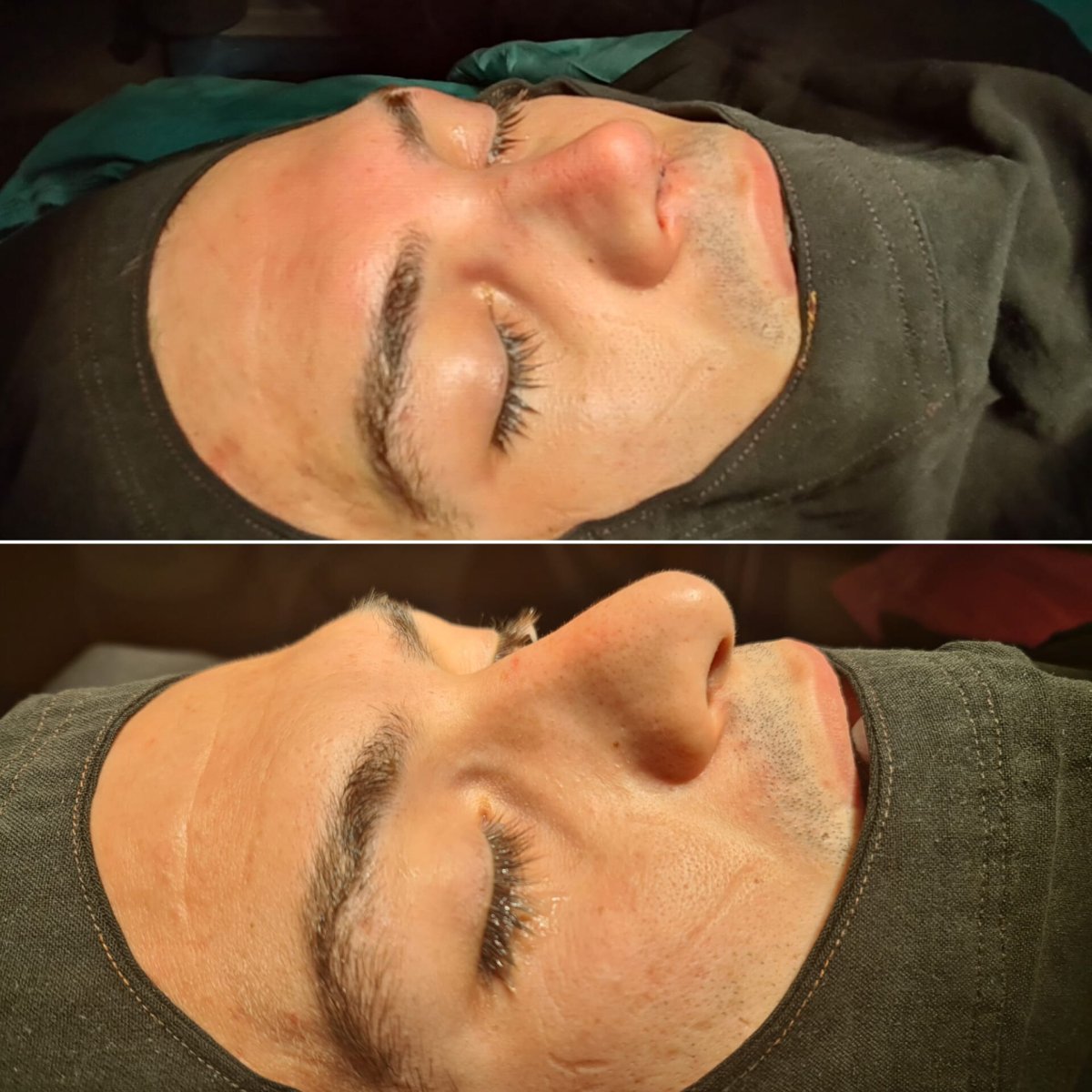 Resultados de rinoplastia antes y después en ÜMRAN TIP MERKEZİ, mejora de la forma nasal