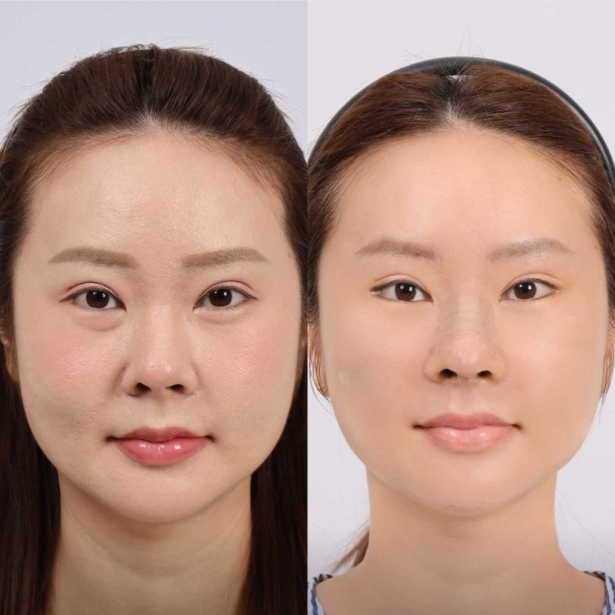 نتائج قبل وبعد شد الوجه العميق في Dr. Chen Surgery Hospital International Center