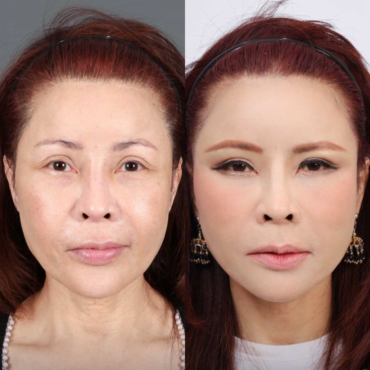 نتائج قبل وبعد شد الوجه العميق في Dr. Chen Surgery Hospital International Center