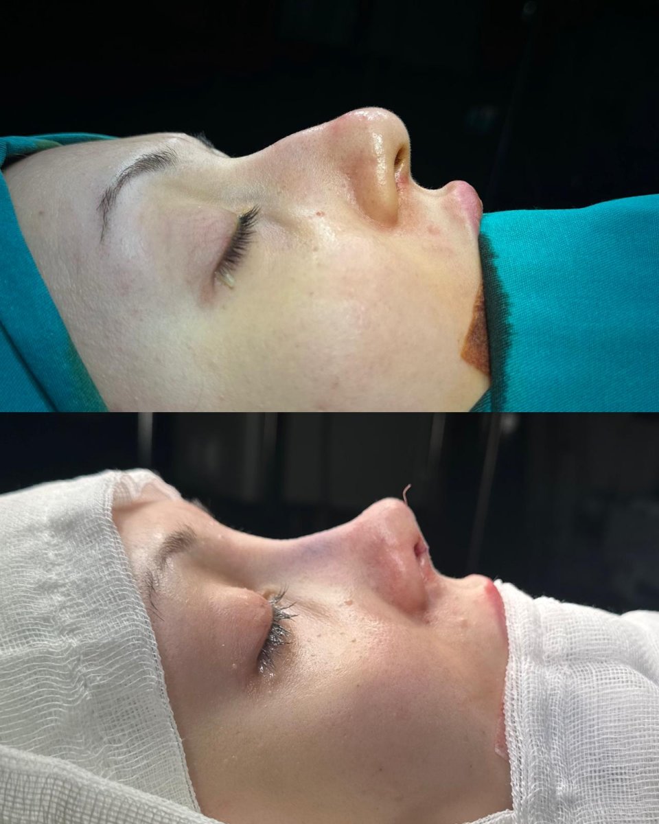 Resultados de rinoplastia antes y después en ÜMRAN TIP MERKEZİ, perfil nasal mejorado