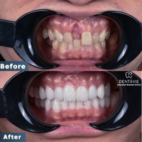 Hollywood Smile procedure with 24 zirconium crowns - photo 4