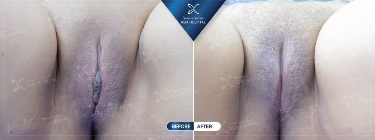 Résultats avant et après labiaplastie à Asia Cosmetic Hospital, aspect des lèvres amélioré
