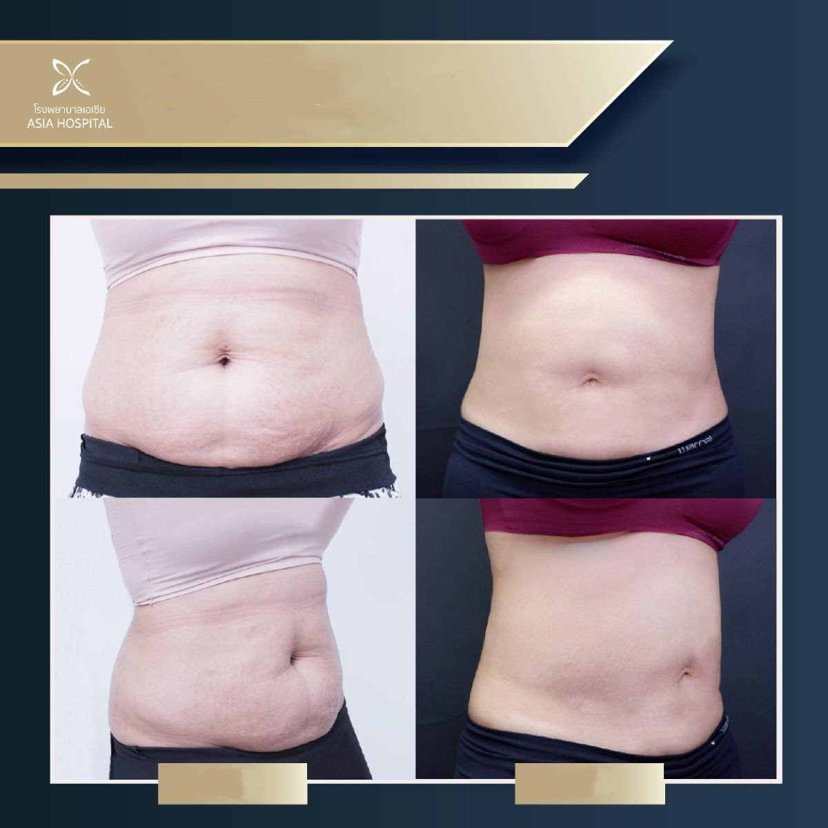 Vorher-nachher-Ergebnisse der Bauchliposuktion in der Asia Cosmetic Hospital, sichtbare Kontur