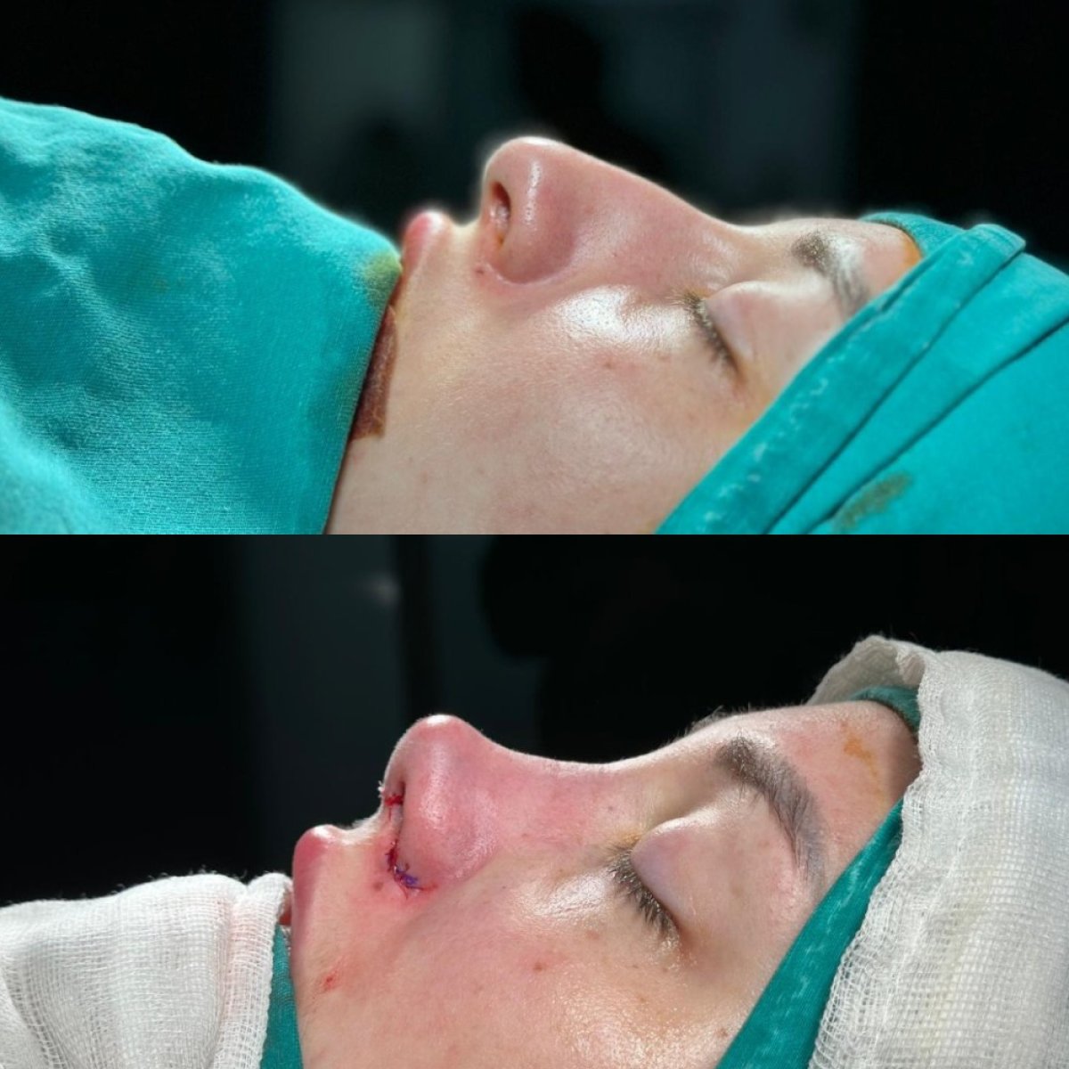 Resultados de rinoplastia antes y después en Büyük Anadolu Hospitals (BAH), cirugía nasal