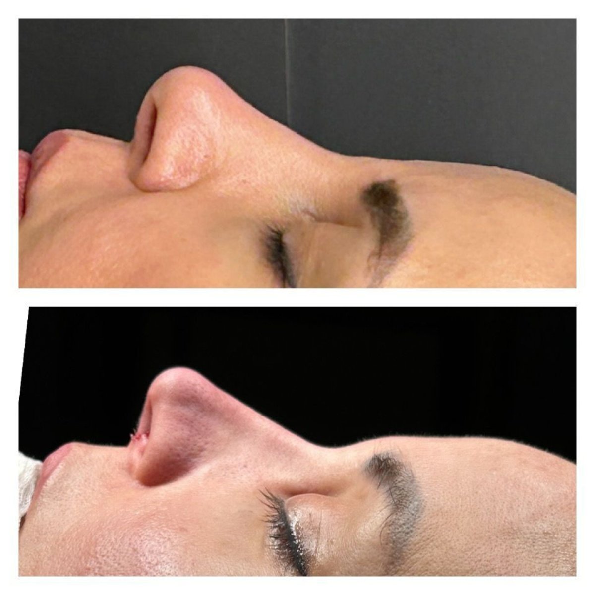 Before and after septoplasty results at Memorial Şişli Hospital, improved nasal profile