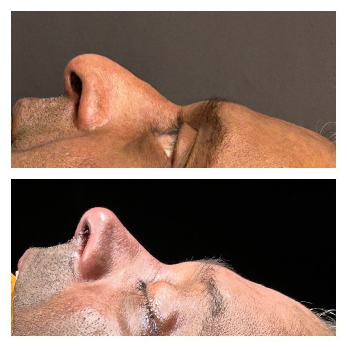Before and after septoplasty results at Memorial Şişli Hospital, improved nasal profile