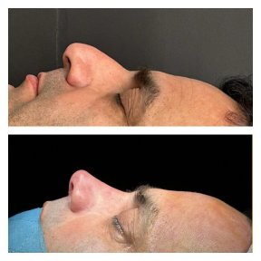 Septoplasty or SMR (Submucous Resection) - photo 6