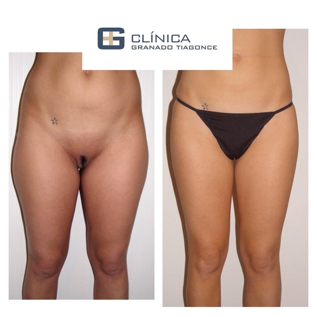Before and after liposuction results at Clinica Granado Tiagonce, improved body contour