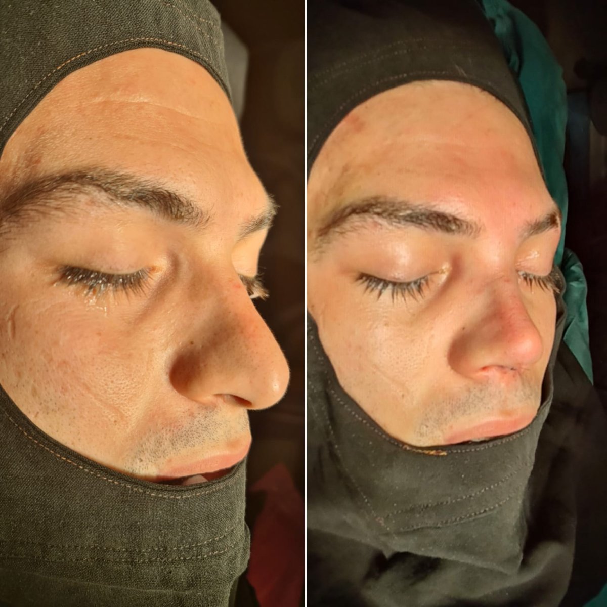 نتائج قبل وبعد عملية تصحيح الحاجز الأنفي في ÜMRAN TIP MERKEZİ، تحسين الشكل والتنفس